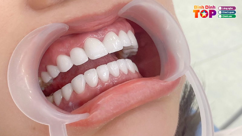 Top-10-dia-chi-boc-rang-su-binh-dinh-dep-va-an-toan