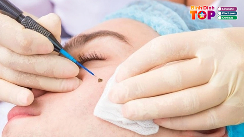 Top-5-dia-chi-xoa-not-ruoi-binh-dinh-dep-an-toan-khong-dau